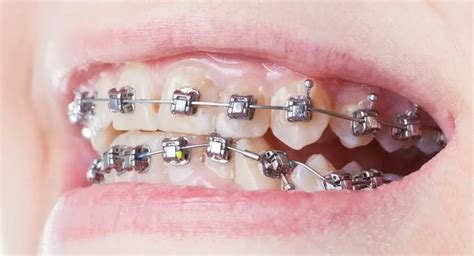 Self Ligating Braces Vs Metal Braces Cost Pros And Cons Pictures Faqs