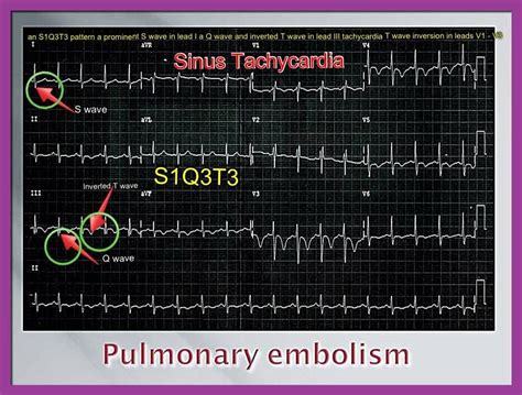 Longembolie Ecg Pulmonary Pressures And Ecg Patterns Ems 12 Lead