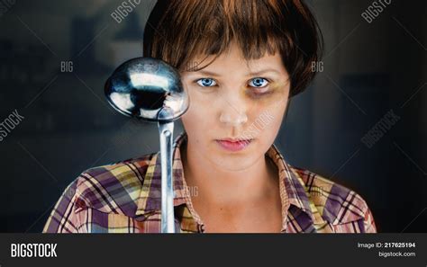 Woman Bruise On Her Image And Photo Free Trial Bigstock