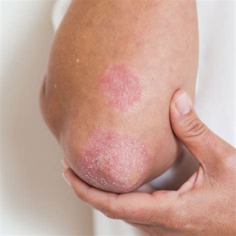 What Is Psoriasis Images And Photos Finder