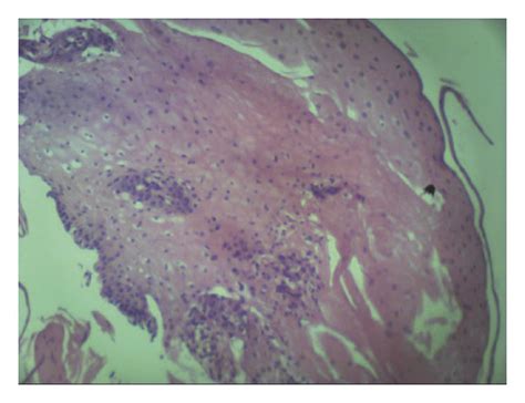 Pathologic Findings Of The Lower Esophagus Revealed Squamous Cell