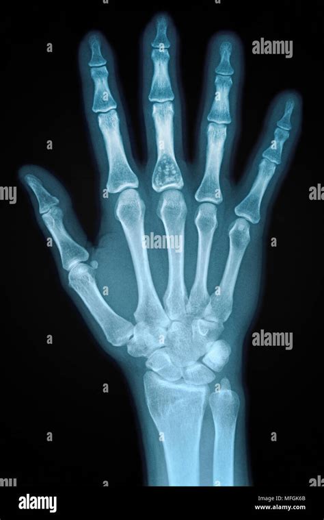 Hand X Ray Of An Adult Female Stock Photo Alamy