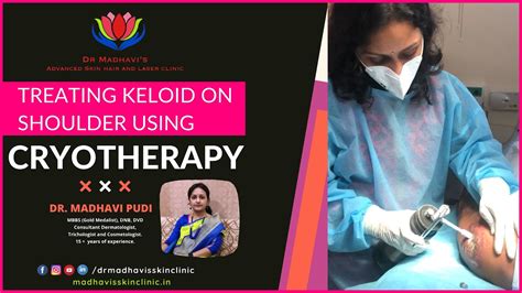 Keloids Treatment On Shoulder With Cryotherapy Painless Cryotherapy