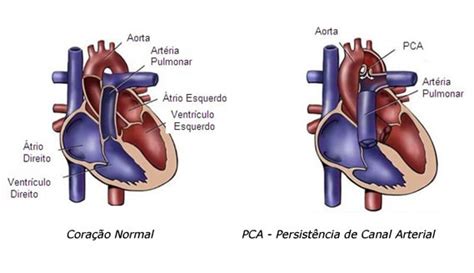 Pca Persistência De Canal Arterial Dr Bruno Rocha