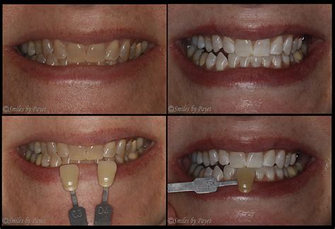 Teeth Bleaching Before And After