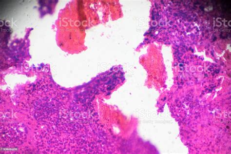 Kidney Adenocarcinoma Biopsy Under Light Microscopy Stock Photo