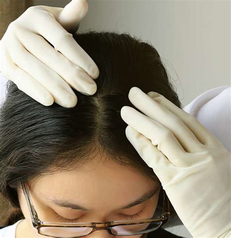 Scalp Acne Treatment Causes And Prevention