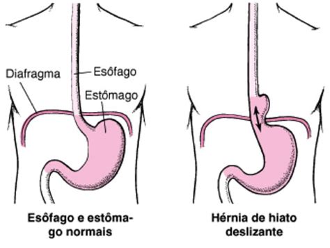 Hernia Center Hérnia Hiatal E Refluxo Gastroesofágico
