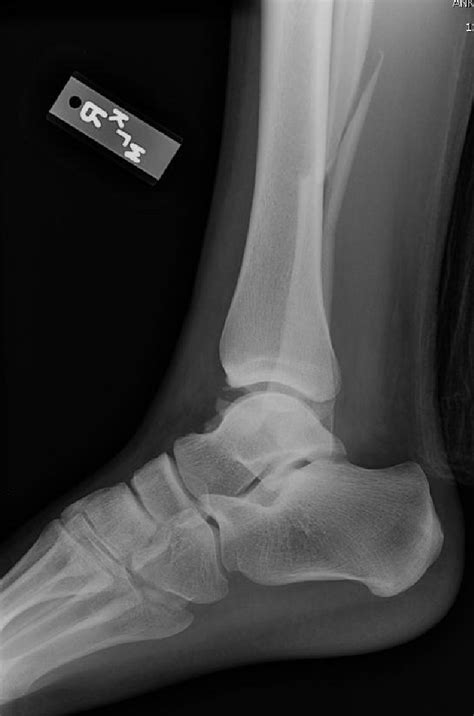 Figure 2 From Early Ambulatory Treatment Of Ankle Fractures Utilizing