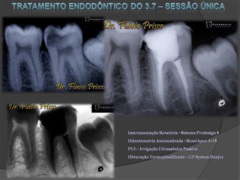 Descobrindo e explorando a Endodontia Tratamento Endodôntico do elemento