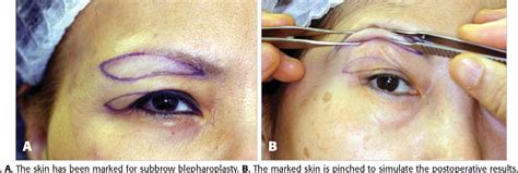 Figure 5 From Subbrow Blepharoplasty For Upper Eyelid Rejuvenation In