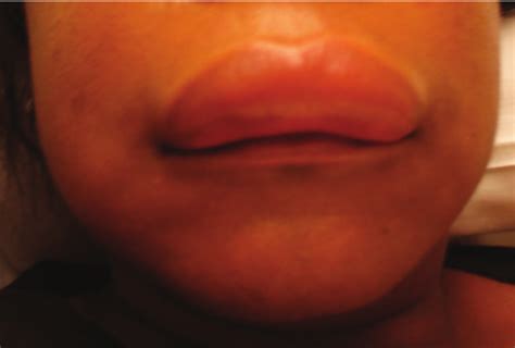 Swelling Upper Lip Angioedema Sitelip Org