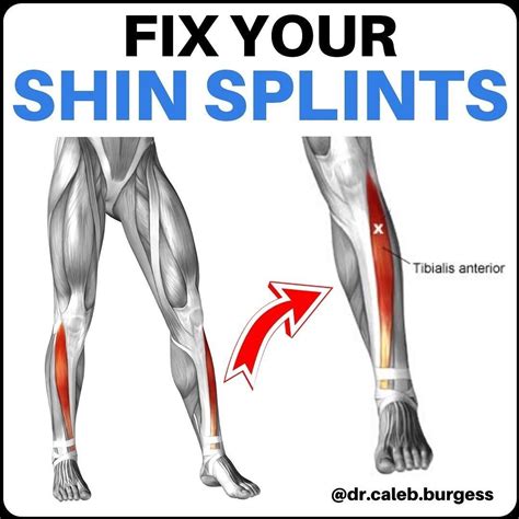 Image Result For Tibialis Anterior Shin Splints Shin Splints My Xxx Hot Girl
