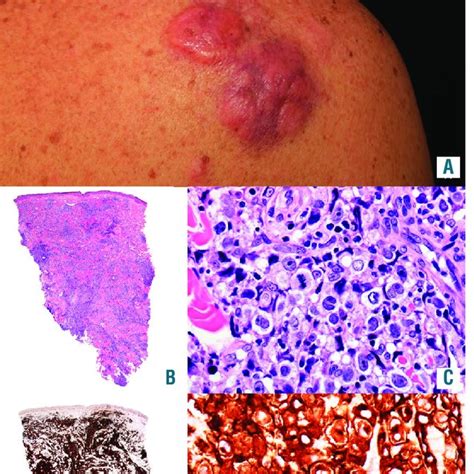 Alk Positive Primary Cutaneous Anaplastic Large Cell Lymphoma A