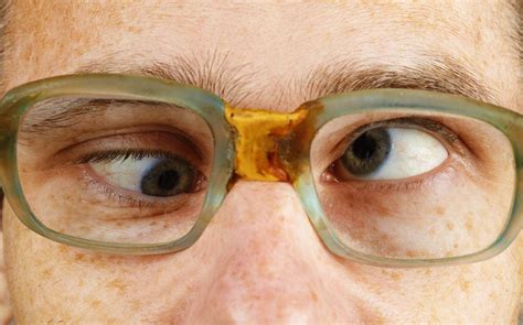 4 Types Of Strabismus Eye Health Facts Medical Wallpa