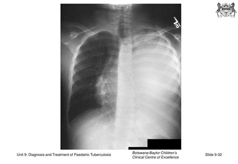 Ppt Unit 9 Diagnosis And Treatment Of Paediatric Tuberculosis