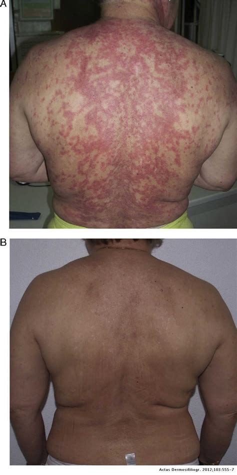 Refractory Subacute Cutaneous Lupus Erythematosus Treated With