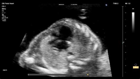 Fetal Echo Hypoplastic Rv Sujyotheartclinic