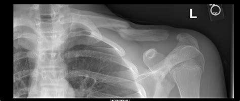 X Ray Broken Collar Bone