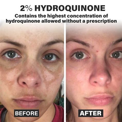 Hydrocortisone And Pigmentation What You Need To Know Justinboey