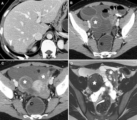 Ovarian Multifocal Bowel And Perihepatic Endometriosis Lesions In A