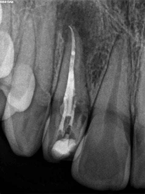 Maxillary Lateral Incisor With Dens Invaginatus Root Canal Specialty