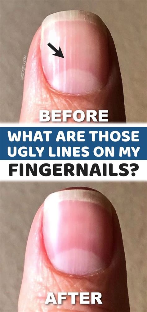 What Those Vertical Lines On Your Nails Mean About Your Health Lines