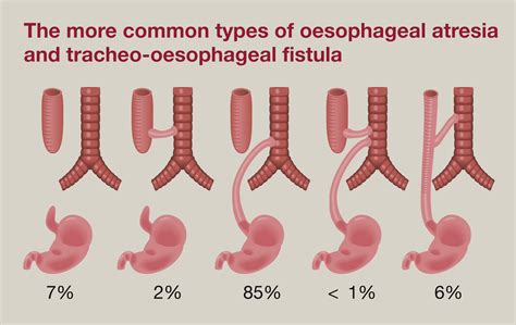 Oesophageal Atresia And Tracheo Oesophageal Fistula Surgery Oxford