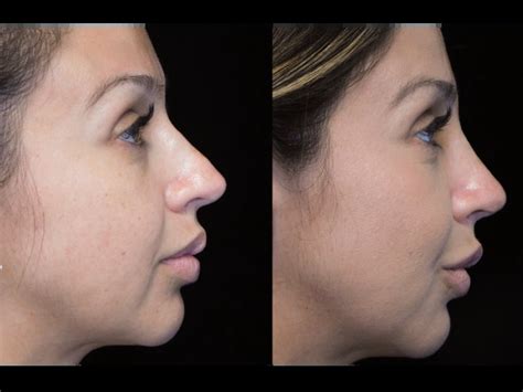 Getting A Bulbous Nose Job Scarless Med Spa By Deepak Dugar Md