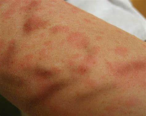 Itchy Skin Rash Pictures Causes Symptoms Treatment Hubpages