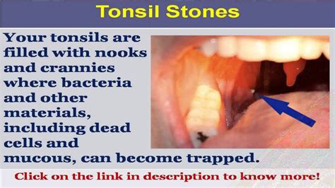 See Now Tonsil Stones Cancer Youtube