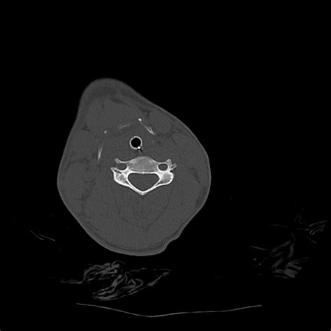 Atlanto Occipital Dissociation Traynelis Type 1 C2 Teardrop Fracture