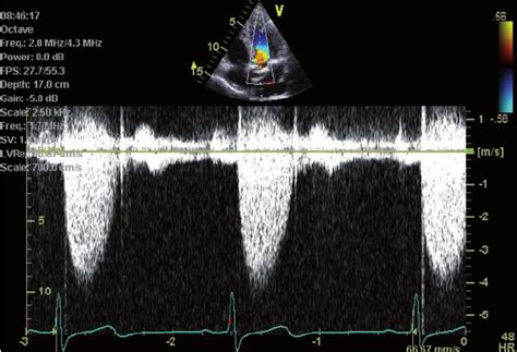 Continuous Wave Doppler Echocardiogram In Patient With Severe Aortic