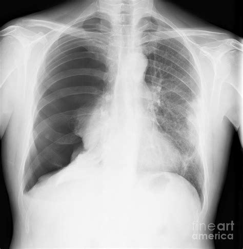 Pneumothorax X Ray Photograph By Science Photo Library Pixels