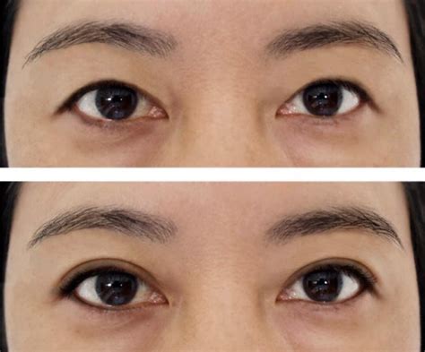 Double Eyelid Surgery In Korea Definition Procedure Benefits