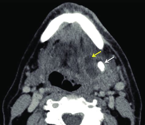Salivary Gland Abscess A 69 Year Old Male Presents With Left