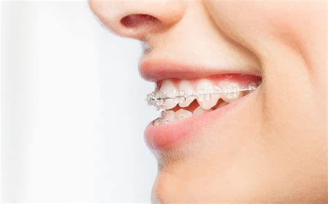 Come Curare La Malocclusione Dentale Con L Ortodonzia