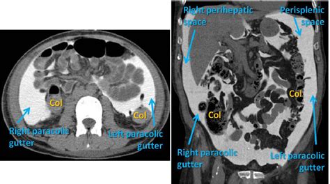 Figure 15 From Peritoneal Cavity Anatomy In Ct Peritoneography A