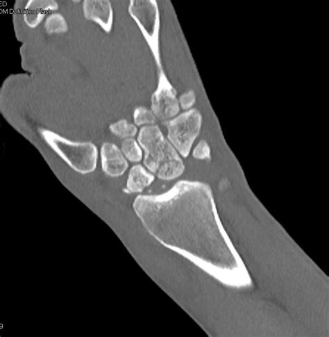 Fracture Dislocation Of The Carpal Bones Musculoskeletal Case Studies