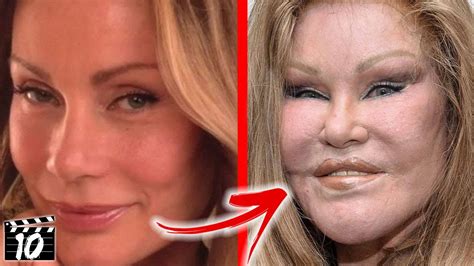 Top 10 Celebrities With Terrible Plastic Surgery Youtube Vrogue