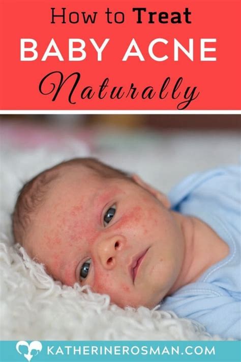 How To Treat Baby Acne Naturally At Home With Proper Hygiene