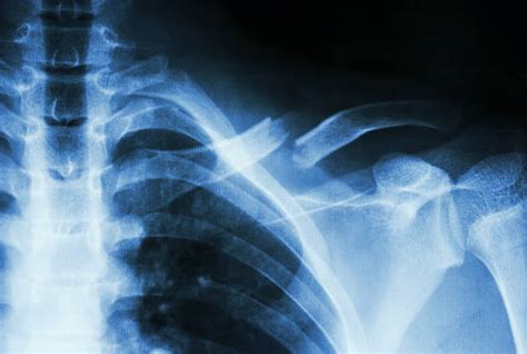 Broken Collar Bone X Ray Stock Photos Pictures And Royalty Free Images
