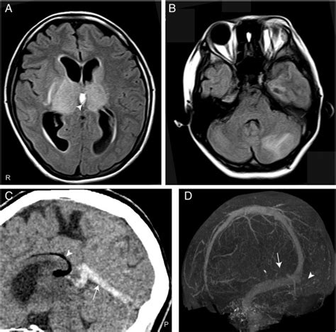 Axial Mri A B Sagittal Ct C And Ct Venography D Images Of The