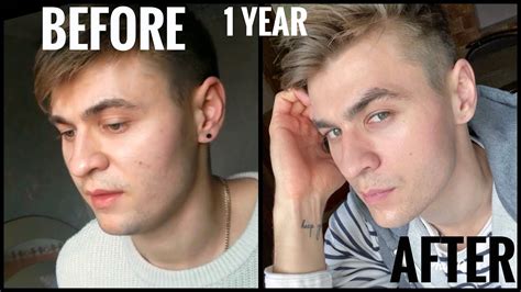 Mewing For 1 Year My Experience Before And After Change Your Face