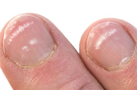 White Spots On Nails Pictures Causes Treatment 2018 Updated