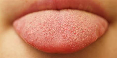 Burning Tongue Syndrome Symptoms Causes Home Remedies And Relief