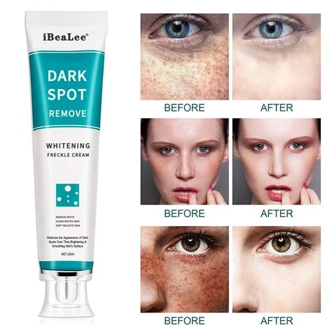 Whitening And Freckle Removal Cream