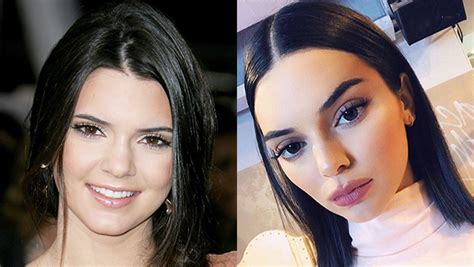 Kendall Jenners Lips Over Time Pics Of Her Pouts Evolution