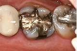 Images of Dental Silver Fillings