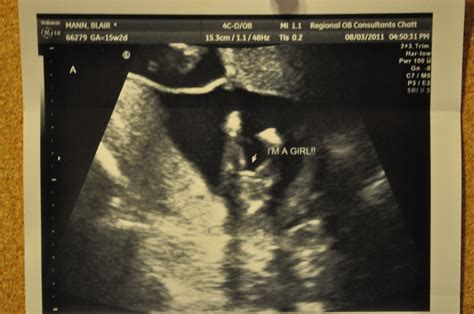 Little Mann Girls Ultrasound 15 Weeks